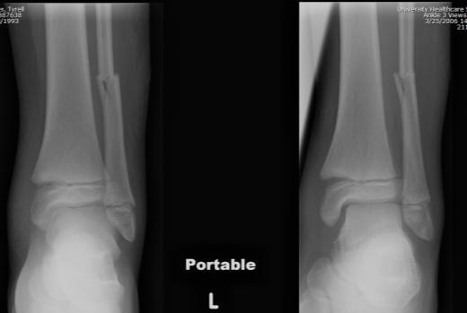 2 Introduction: A common scenario: It is a Sunday morning and a 10 year old male presents to the emergency room having sustained an injury to his left ankle in a sandlot football