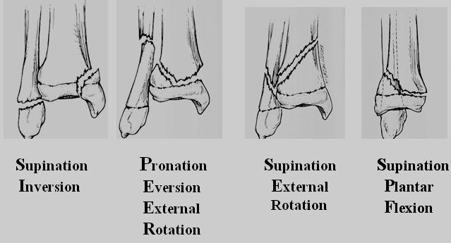 4 Figure 2. The four fracture patterns of the Dias Tachdjian Classification C.