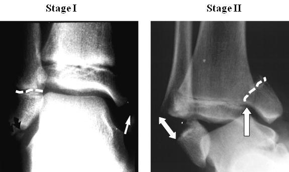 5 Figure 1 Supination- Inversion patterns Stage I demonstrates only a fracture in the lateral fibular physis (dotted line).