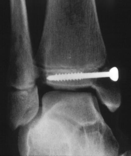 Following the reduction of both fractures, the medial