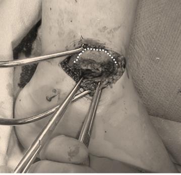 Injury image of typical PEER lesion. b.