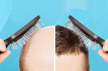 Frequently Asked Questions About Hair Transplantation?