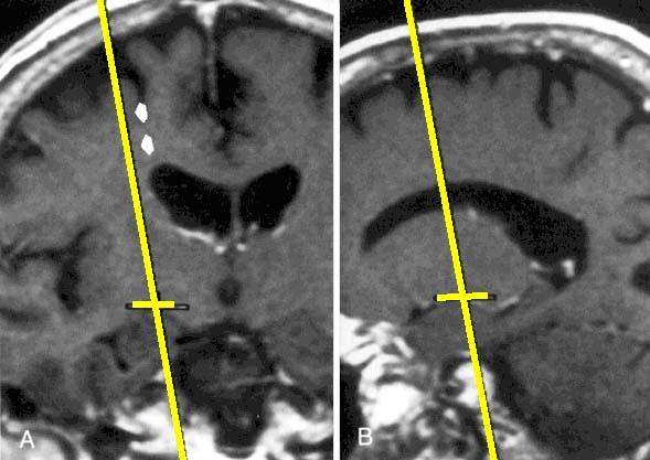 This is a perioperative MRI of a patient whose PD was relieved by lesions of the internal part of the globus pallidus in the coronal (left) and parasagittal (right) planes.! Lecture XIII.