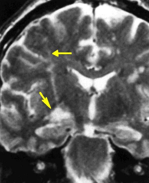 This is a post operative MRI in the coronal plane of a patient whose PD was relieved by lesions of the internal part of the globus pallidus.
