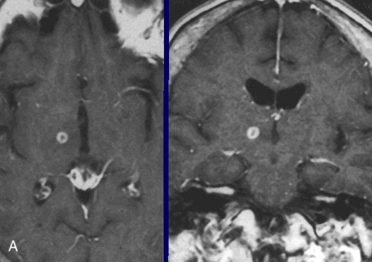This is a post operative MRI of a patient whose PD was relieved by lesions of the thalamus.