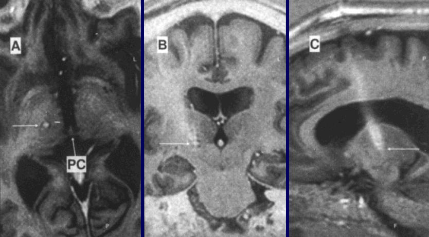 These are postoperative MRIs of a patient whose PD was relieved by electrical stimulation of the subtalamic nucleus.