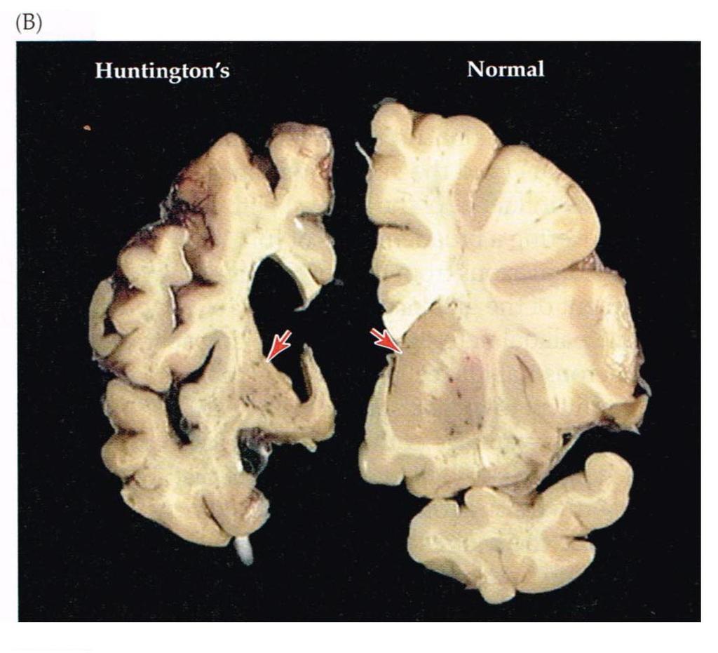 NEUROSCIENCE,! fig 18.9 B, p. 408! Atrophy (shrinkage) of! the Caudate Nucleus and of the Putamen!
