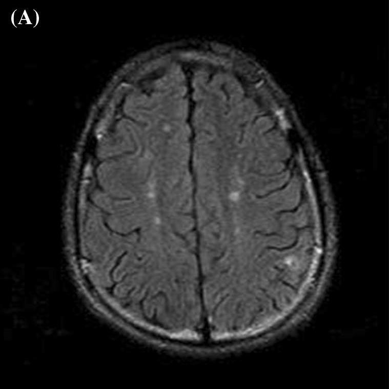 Parenchymal defects in 31 MRIs (23.3 %) - CVDs 4. Cerebral atrophy in 20 MRIs (15.