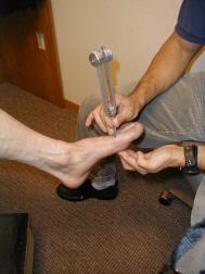 volts. Probe is placed at distal hallux Amplitude is adjusted until the patient can distinctly sense the stimulus.