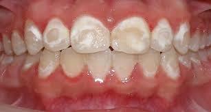 2 Cellulitis and abscess of mouth Direct Referral: Caries activity visible as white spots or small brown areas.