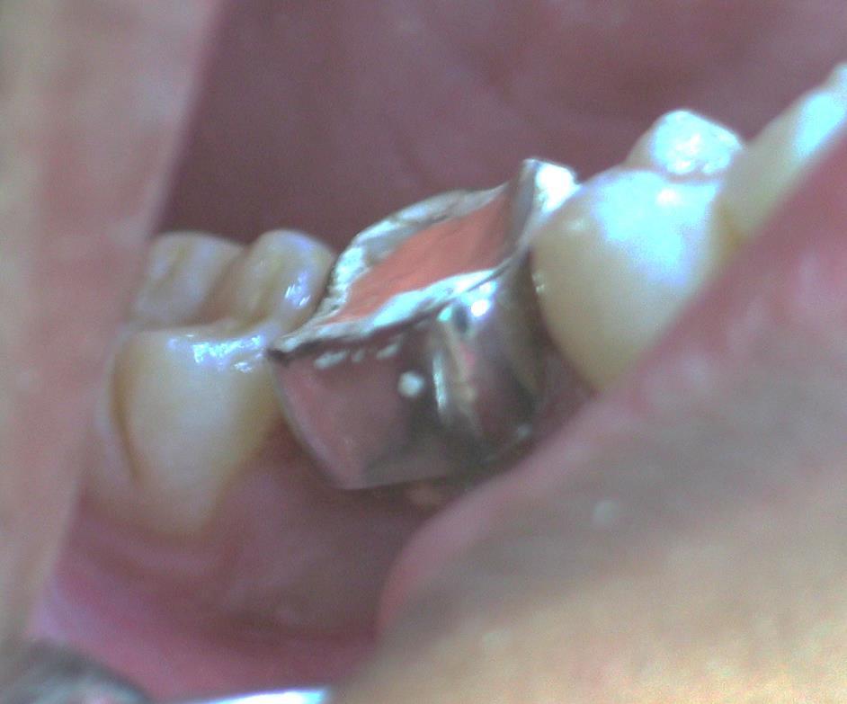 Glass ionomer cement Tooth