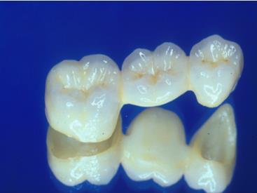 Reduction indices for controlling tooth preparation An appreciation of the laboratory aspects of