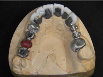 problem of last standing tooth Have an understanding of the planning and restorative stages in the complex