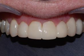 selection and adaptation including the Bioclear Veneer Matrix Clark 2-step Polish technique Clark Class III cavity design with