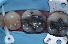 Treatment using the Opportunistic Class II Direct composite Overlay