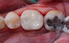 molding Treatment of the adjacent tooth using the Opportunistic Class II