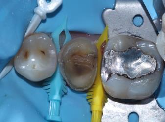 with Bioclear Molar Overlay Learning objectives Understand the theory and