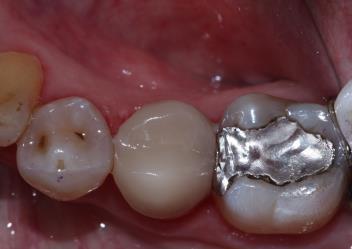 caries in adjacent teeth using the opportunistic Class II cavity Be able