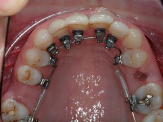 orthodontics, aesthetic and functional restorative aspects The role of the GDP in Orthodontics o Advantages and limitations Current systems o Advantages and limitations Aesthetic and