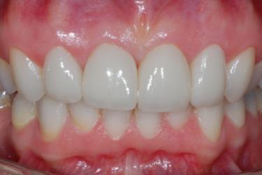 understanding of aligners, conventional and lingual appliances in the adult orthodontic patient The role of orthodontics in an interdisciplinary approach to functional aesthetic