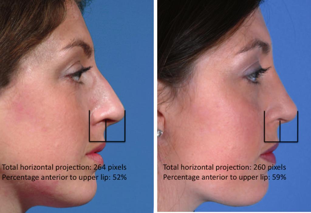Plastic and Reconstructive Surgery May 2012 Fig. 3. Preoperative and postoperative photographs after rhinoplasty with alar base resection.