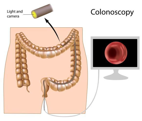 General Instructions Medications Your doctor has referred you for a colonoscopy. Based on your doctor s order, you will be given sedation or anesthesia for this procedure.
