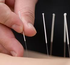 Acupuncture PATIENT INFORMATION SHEET What is acupuncture? Acupuncture is one component of traditional Chinese medicine that has been used for over 2,000 years to treat many health conditions.