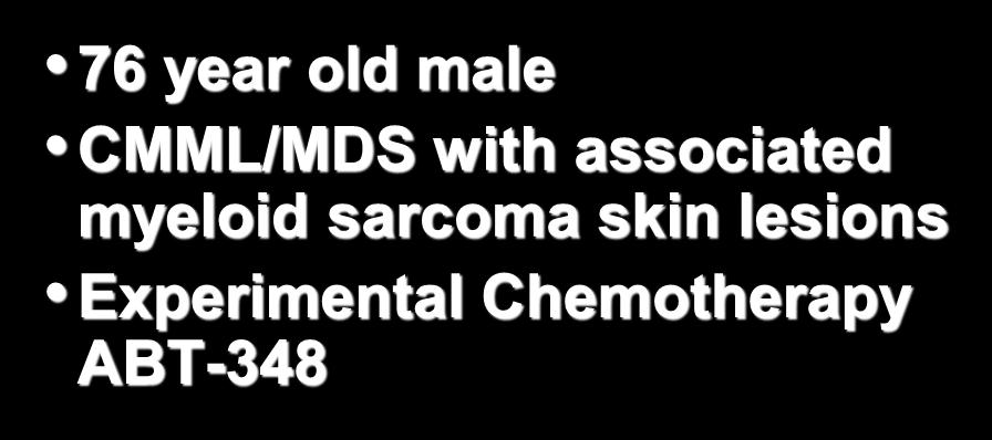 76 year old male CMML/MDS with
