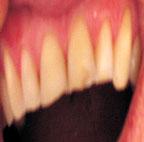 The development and the degree of dental erosion depend on the longevity of action and the frequency of contact with the damaging factor (5, 6).