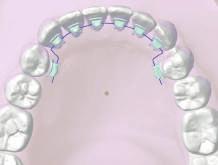 Ravindra Nanda (Temporary Anchorage Devices in Orthodontics. Mosby Elsevier. St Louis, Missouri, 2009).
