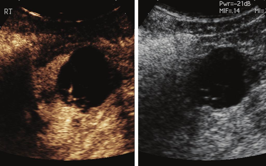 Fig. 2. Benign septated renal cyst on split screen. Left, contrastenhanced US image.