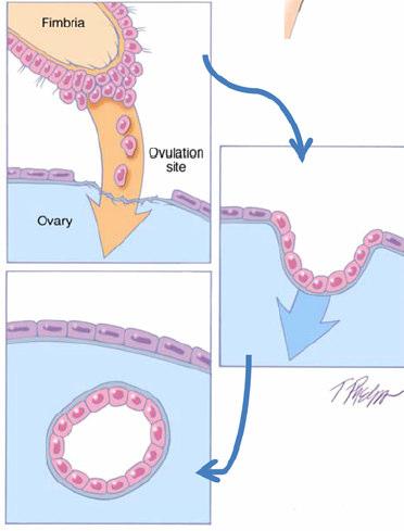 proportion of ovarian carcinomas might develop as a result of implantation of malignant cells from the tubal carcinoma to the ovary Piek JM et al. J Pathol 2001, 195:451-456 Piek JM et al.