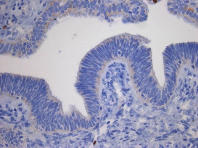 Epithelial pseudoneolasia associated with salpingitis Papillary lesions Benign precursor candidates (secretory cell outgrowth,