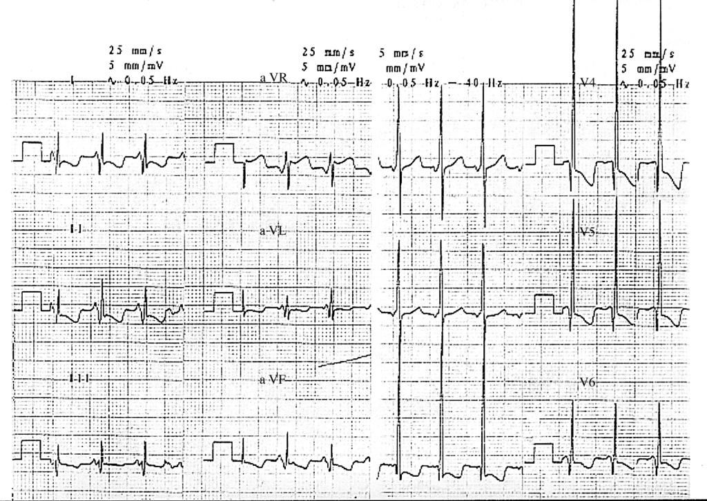 380 Fig. 1 ECG reveals a short PR interval, high QRS voltage, ST-T changes and prominent Q wave in the left precordial leads. was marked hepatomegaly but no splenomegaly.