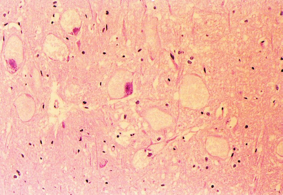A B C Fig. 4 Pathological examinations demonstrate vacuolar changes in the myocardium ((A) H & E stain, 100Ű) and ballooning changes in the motor neurons of the spinal cord ((B) H&E stain, 400Ű).