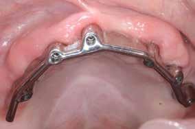 It was decided that a cantilever bar to the 16 area was a good compromise considering that there were six implants in total.