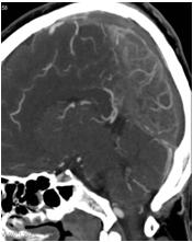 following Sx 10-25% High risk : Hunt & Hess grade 3-4, MCA aneurysm, rebleeding, large hematoma, vasospasm with cerebral infarction, shunt-dependent hydrocephalus, persistent neurological deficits