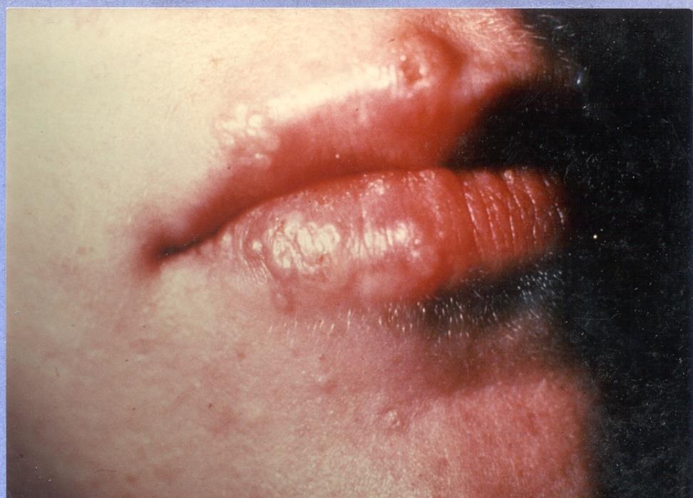 HERPES SIMPLEX VIRUS-1 Cause: Virus (herpes simplex) Symptoms: Causes Cold sores or fever blisters.