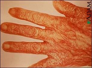 SCABIES Treatment: Prescription Medicated Lotion Complications: Scarring can occur from scratching.