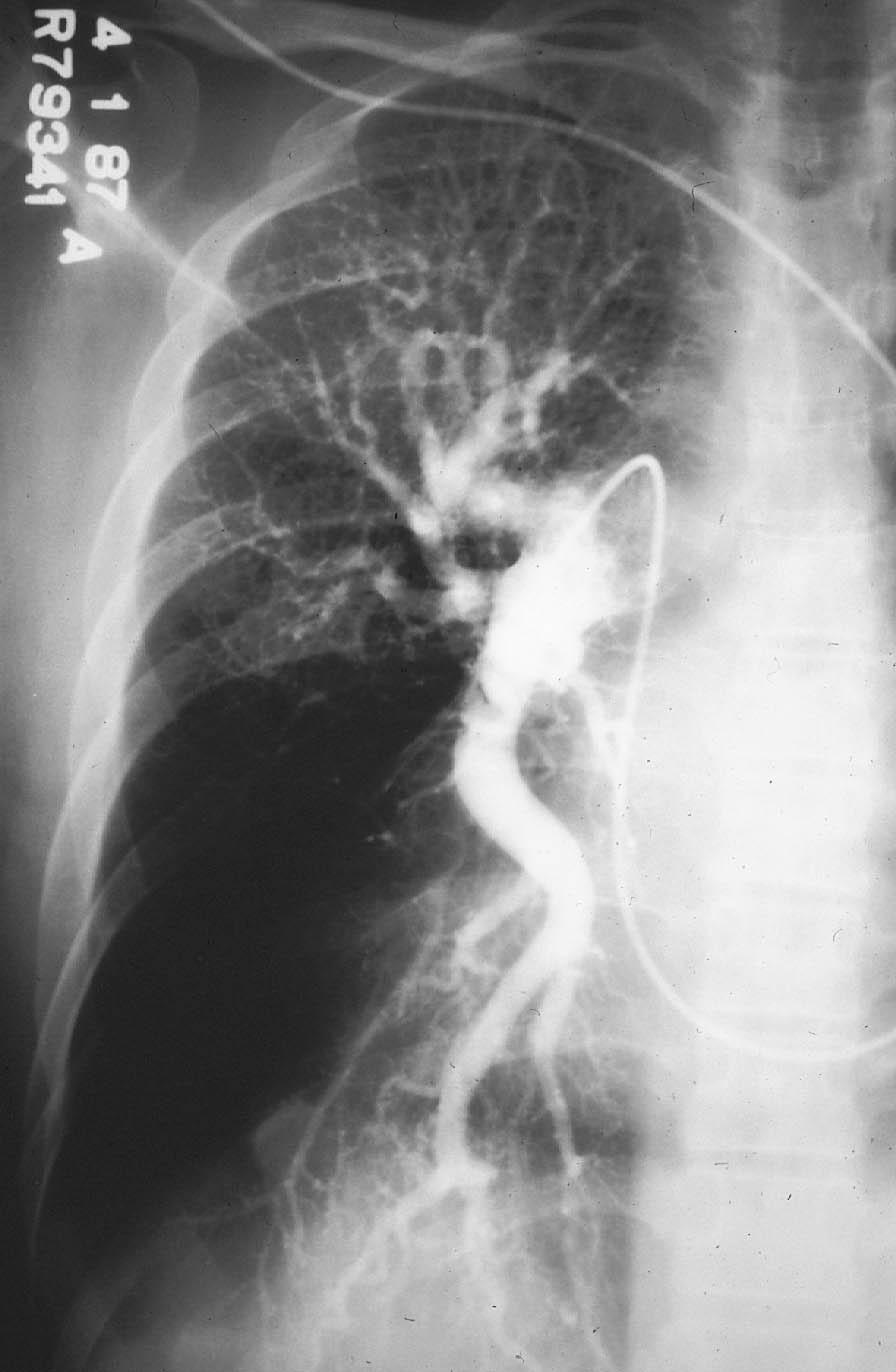 Pulmonary arteriogram, with