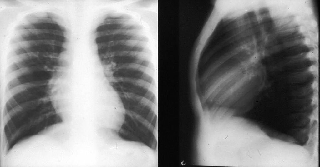 Chest x-ray in asthma (PA &