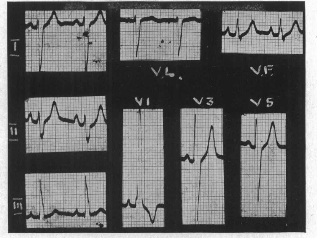 THE ELECTROCARDIOGRAM IN THE TETRALOGY OF FALLOT FIG. 2.