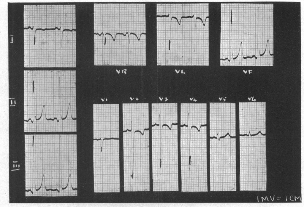 196 ARNOLD WOODS FIG. 4.-An atypical case, in which there was an rs complex in VI and the intrinsic deflection of V6 was greater than that of VI.