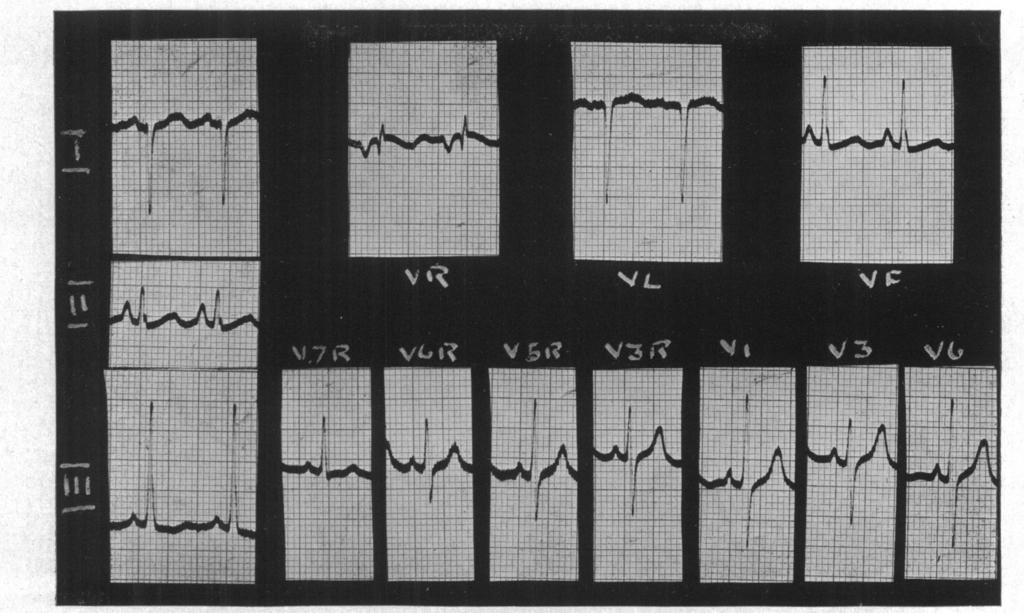 THE ELECTROCARDIOGRAM IN THE TETRALOGY OF FALLOT FIG. 6.