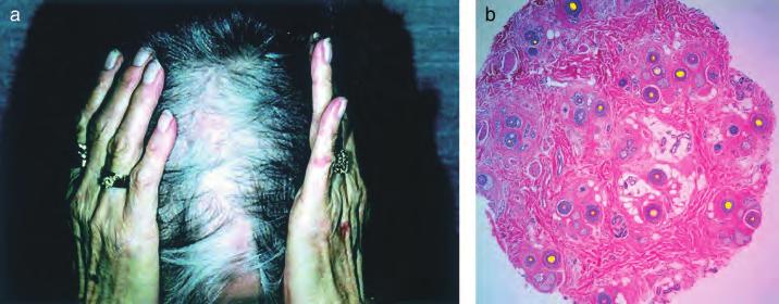 Diffuse scalp hair loss for 1 1 2 y(a, b). Chronic telogen effluvium: Normal numbers of terminal hairs, vellus hairs, and follicular stelae (streamers).
