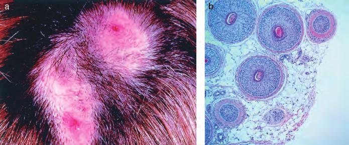 10 : 3 DECEMBER 2005 DERMATOLOGY WORKSHOP, BERLIN 257 Figure 3 Case 3: 31-y-old white female. Patchy hair loss with scarring for 1 y (a, b).