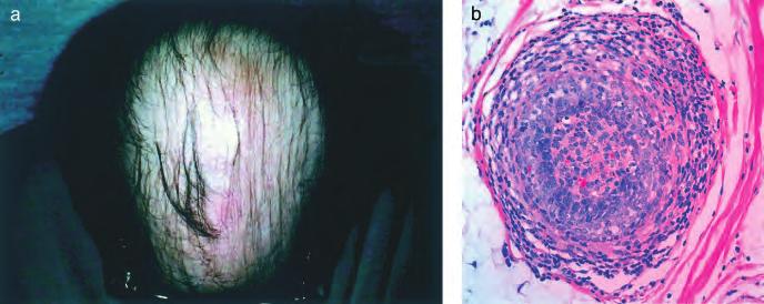 Inflammation only increased if secondary infection present; fibrosis only increased by infection and chronic traction. Figure 5 Case 5: 43-y-old white female. Patchy scalp hair loss for 2 mo (a, b).