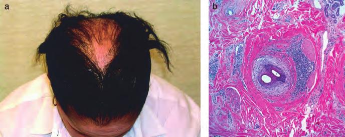 258 WHITING AND HOFFMAN JID SYMPOSIUM PROCEEDINGS Figure 6 Case 6: 53-y-old black female. Spreading scarring on vertex for 2 y (a, b).
