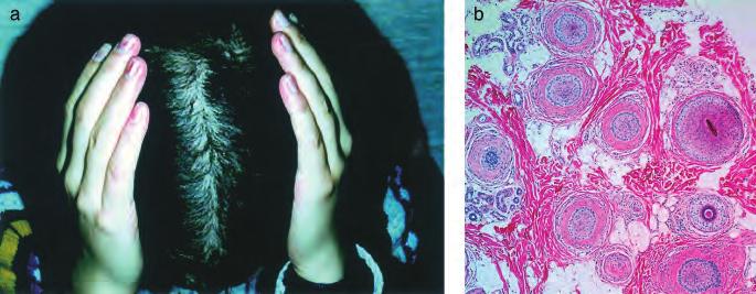 Ingrowing hairs are not seen. Figure 10 Case 10: 20-y-old white female. Patchy hair loss on and off, 3 y (a, b).