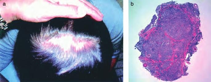 260 WHITING AND HOFFMAN JID SYMPOSIUM PROCEEDINGS Figure 12 Case 12: 39-y-old white male. Several scalp tumors for 5 mo (a, b).